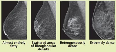 used with permission https://www.acr.org/~/media/ACR/Documents/PDF/QualitySafety/Resources/Breast-Imaging/Breast-Density-bro_ACR_SBI_lores.pdf Breast Density Mammogram Chart